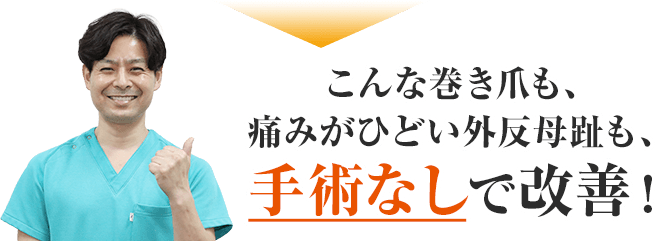 こんな巻き爪も痛みがひどい外反母趾も手術なしで改善を目指します